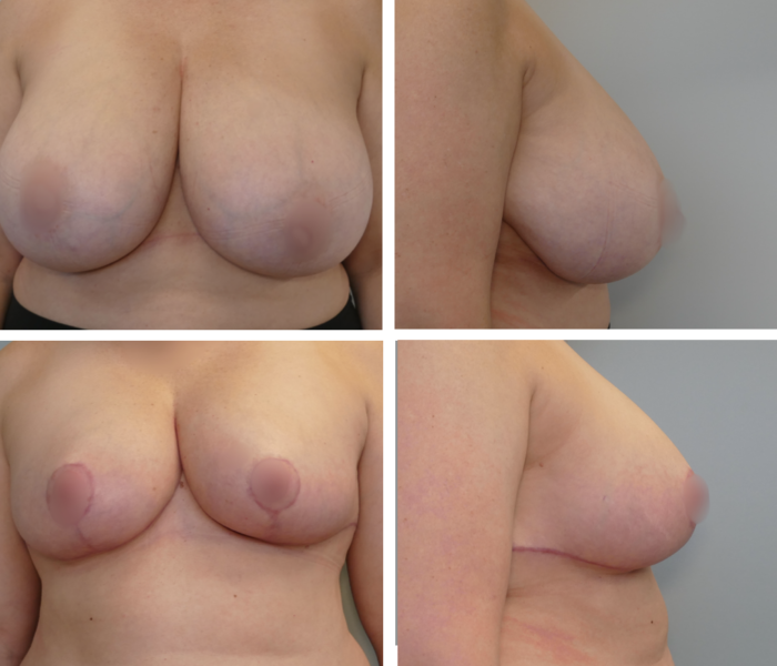 Breast reduction before and after